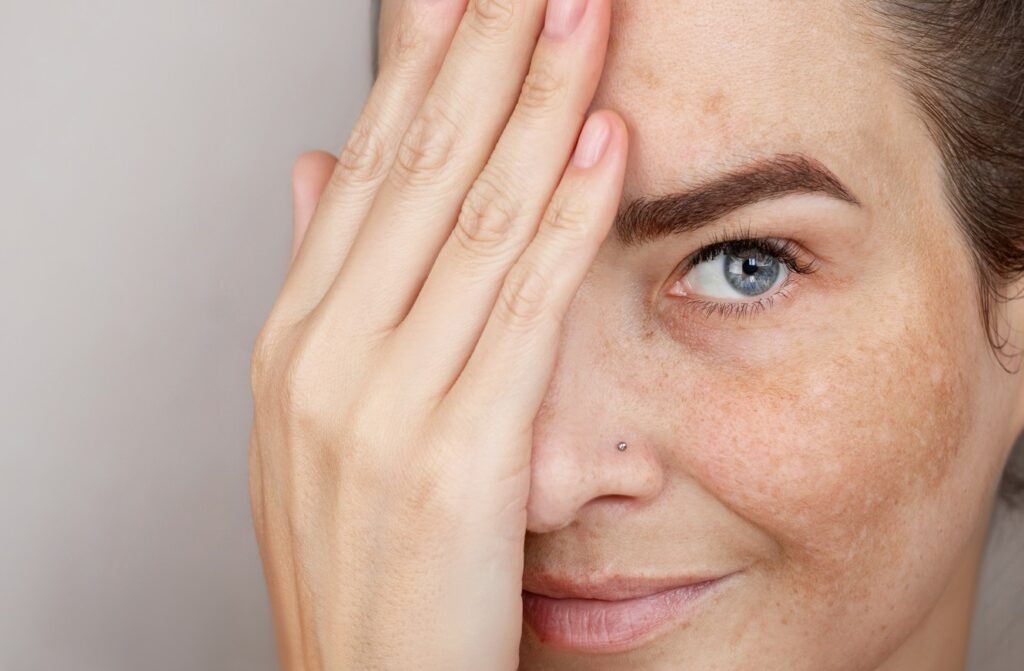 Melasma Skin